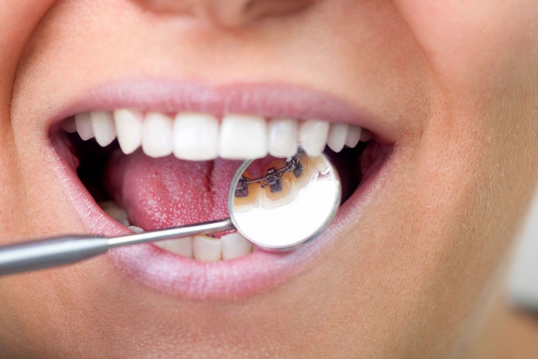 Dentale Untersuchung mit Spiegel